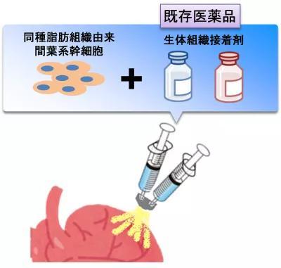 干細胞噴霧 大阪大學為心衰患者點亮新曙光